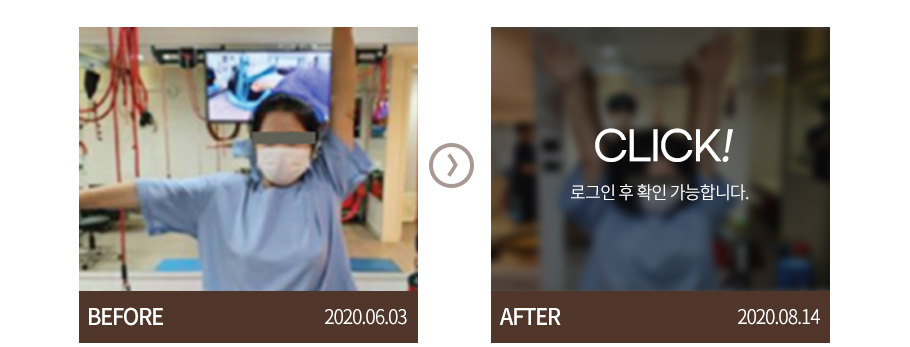 오십견
