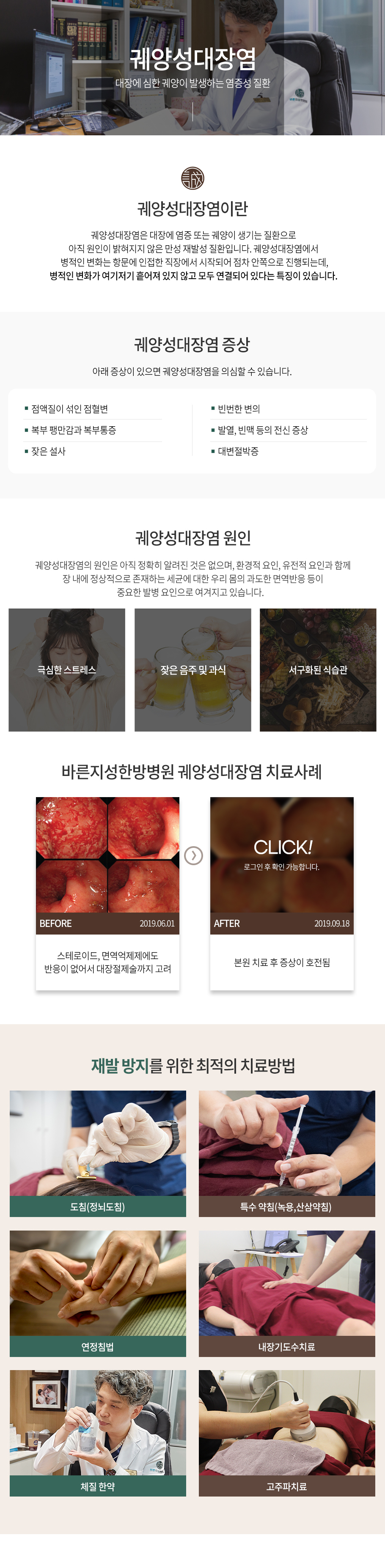 궤양성대장염