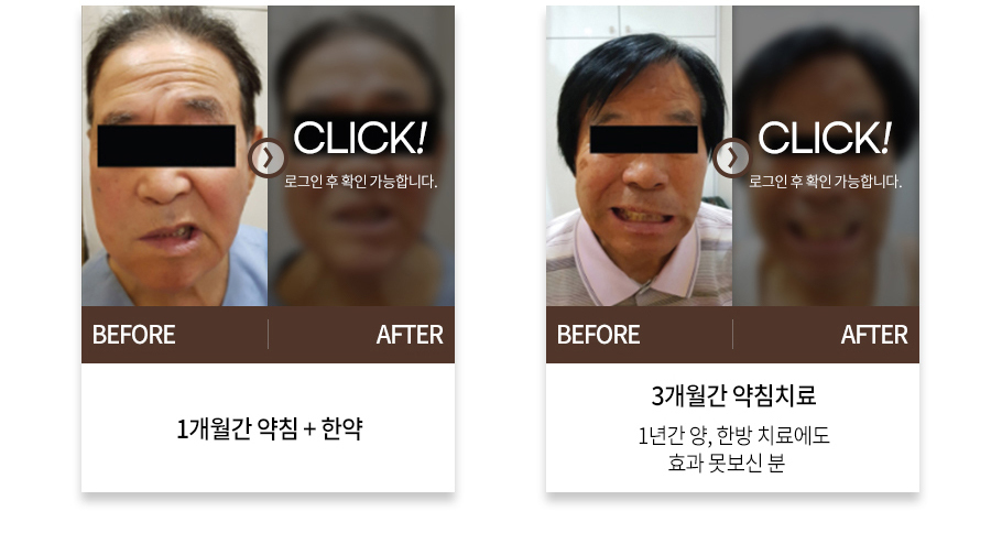 바른 침치료