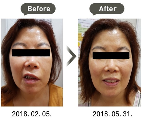 "안면마비" 치험례(60대/여성)