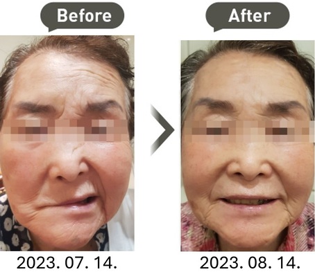 "안면마비" 치험례(70대/ 여성)