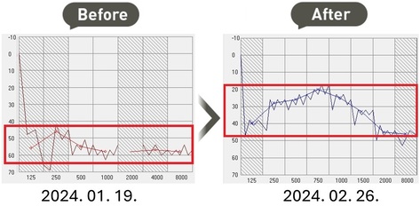 3개월이 지난 돌발성난청 치험례(60대/남성)