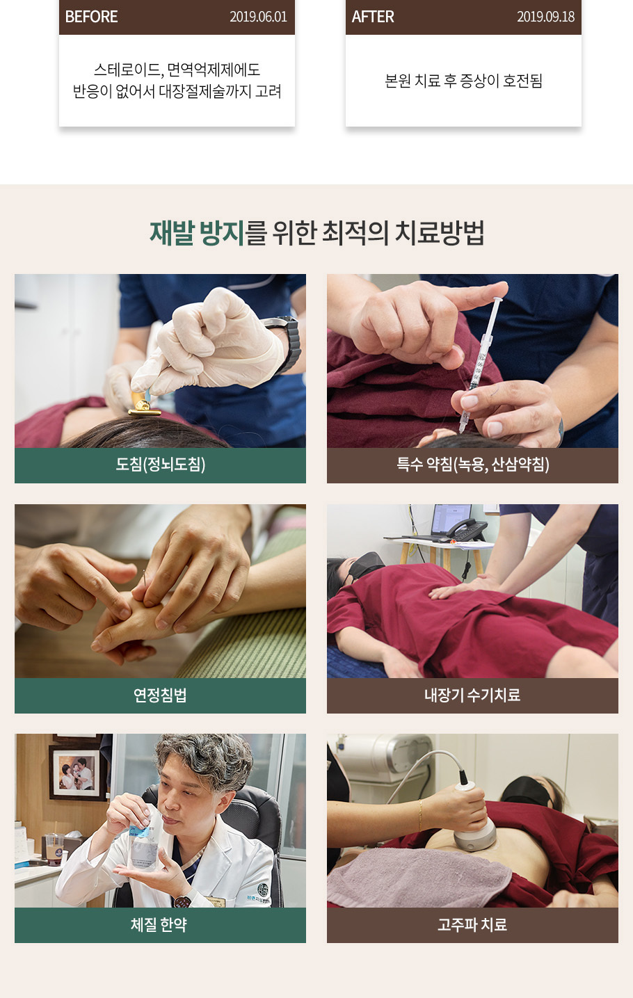 궤양성대장염